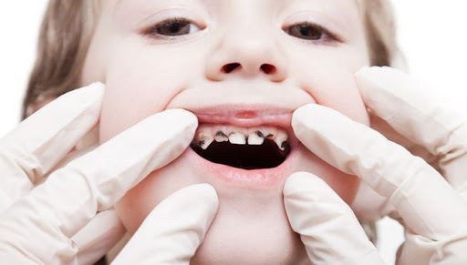 Lapisowanie, lakowanie czy lakierowanie? DENTALCARE. Stomatolog